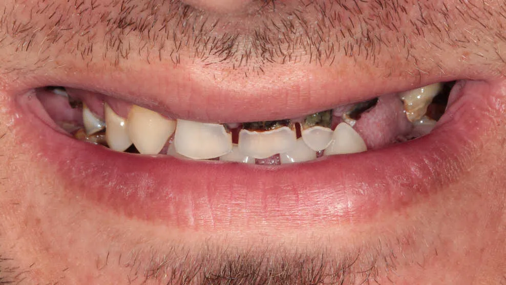 Reabilitare orală complexă bimaxilară - înainte tratament