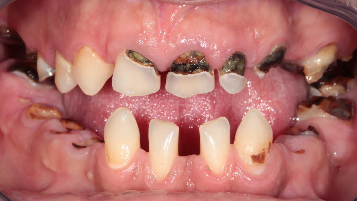 Reabilitare orală complexă bimaxilară - înainte tratament