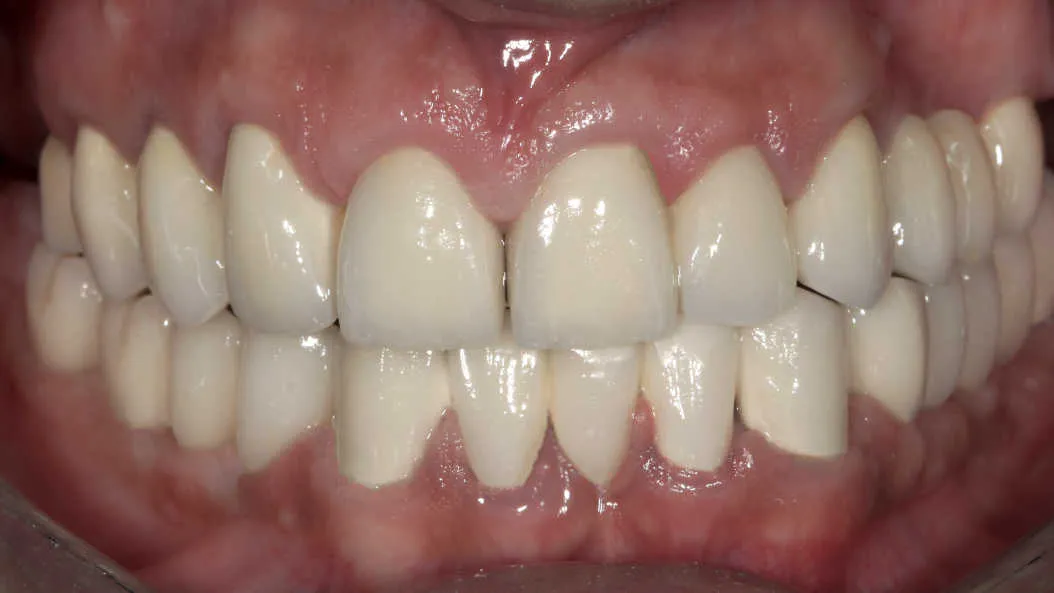 Reabilitare orală complexă bimaxilară - după tratament
