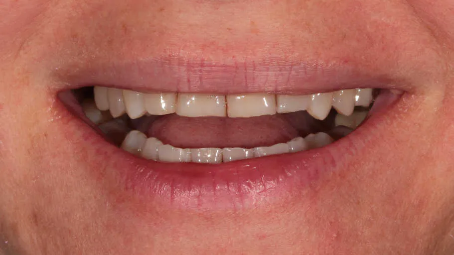 Reabilitare orală complexă în cazul unei paciente tinere cu uzuri și eroziuni dentare accentuate. - înainte tratament