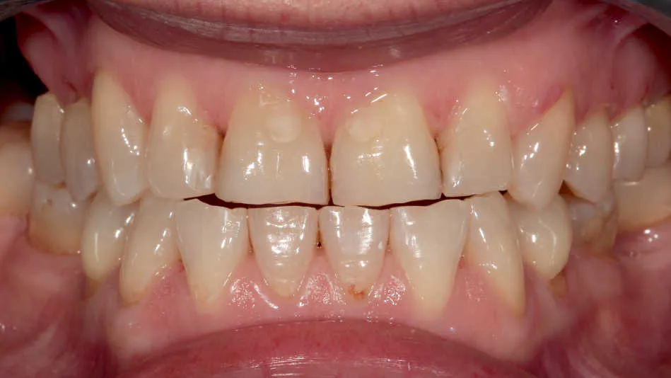 Reabilitare orală complexă în cazul unei paciente tinere cu uzuri și eroziuni dentare accentuate. - înainte tratament