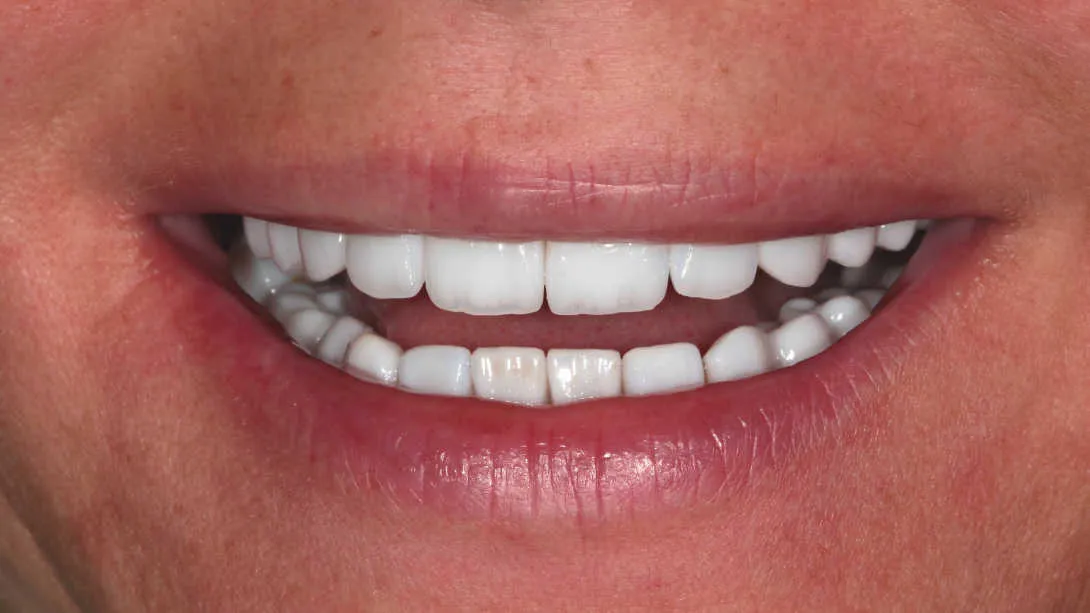 Reabilitare orală complexă în cazul unei paciente tinere cu uzuri și eroziuni dentare accentuate. - după tratament