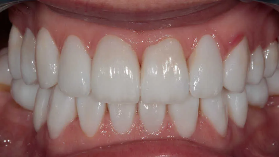 Reabilitare orală complexă în cazul unei paciente tinere cu uzuri și eroziuni dentare accentuate. - după tratament