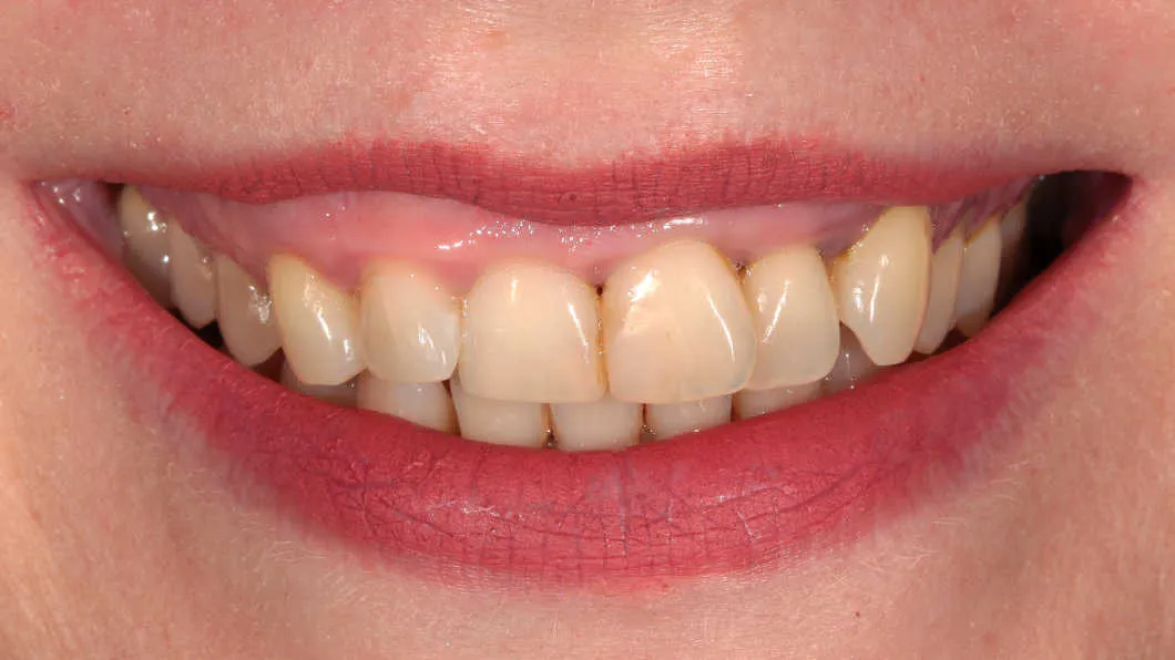Îmbunătățirea funcției și esteticii dentare - înainte tratament