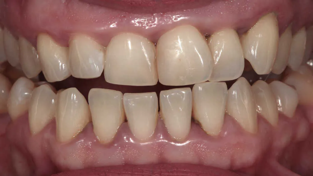 Îmbunătățirea funcției și esteticii dentare - înainte tratament