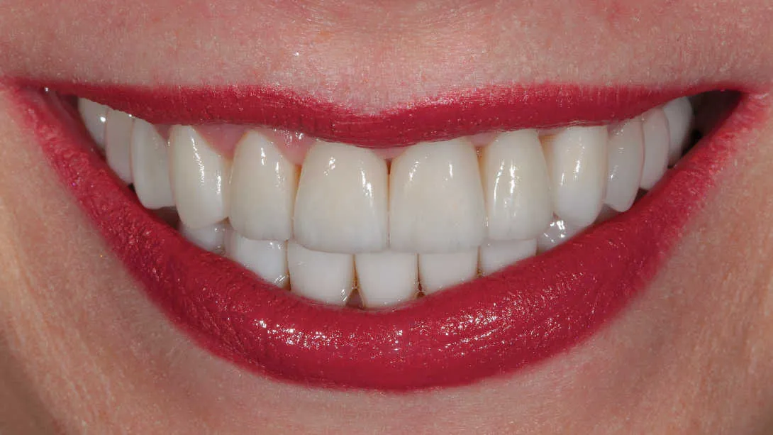 Îmbunătățirea funcției și esteticii dentare - după tratament