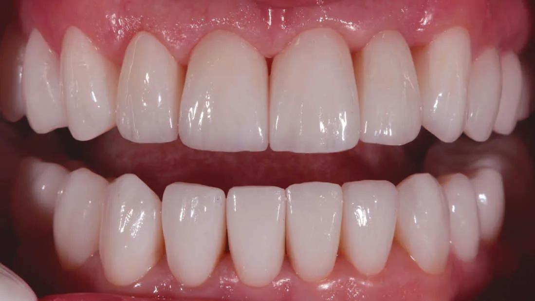 Îmbunătățirea funcției și esteticii dentare - după tratament
