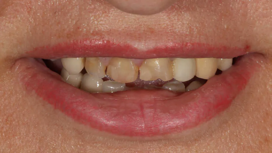 Reabilitare orală bimaxilară - înainte tratament