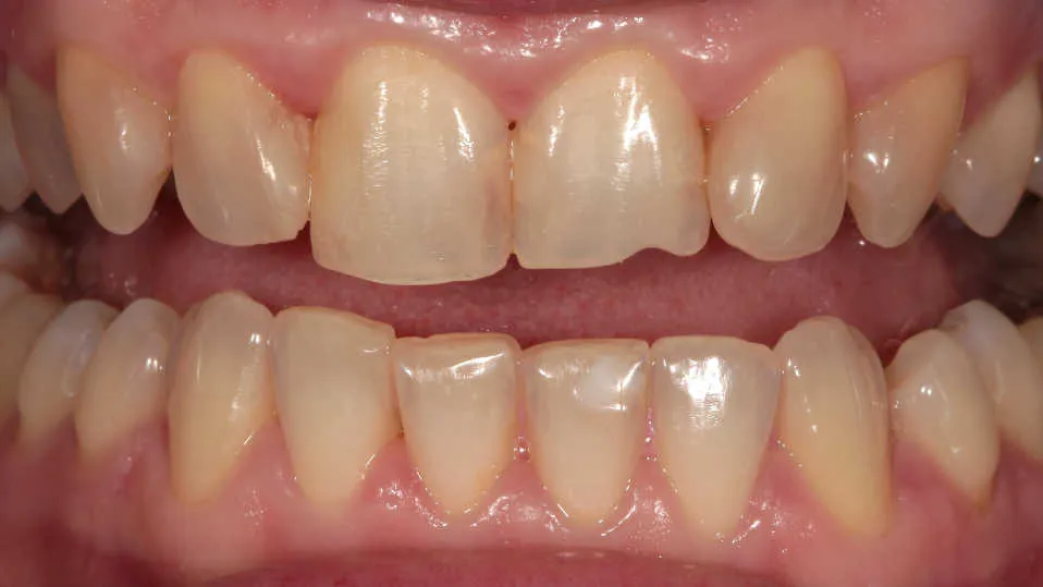 Reabilitare estetică și funcțională a danturii prin restaurări integral ceramice - înainte tratament
