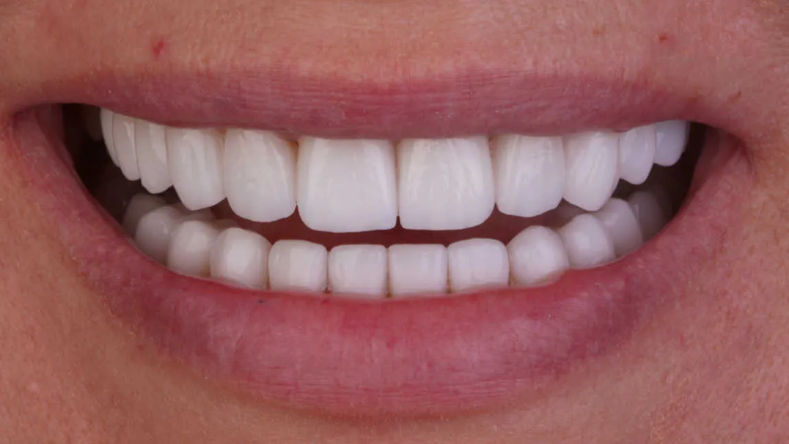 Reabilitare estetică și funcțională a danturii prin restaurări integral ceramice - după tratament