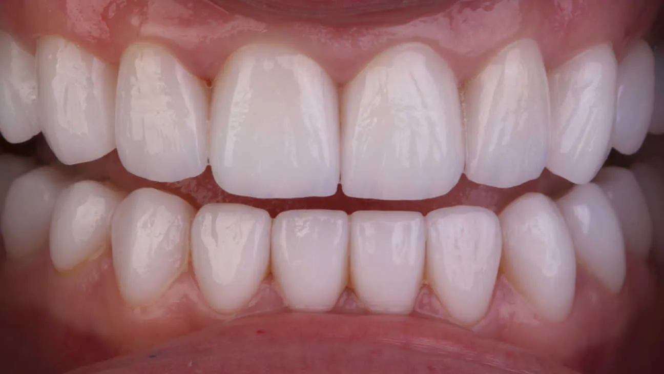 Reabilitare estetică și funcțională a danturii prin restaurări integral ceramice - după tratament