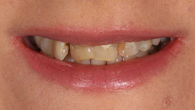 Reabilitare orală estetică și funcțională - înainte tratament