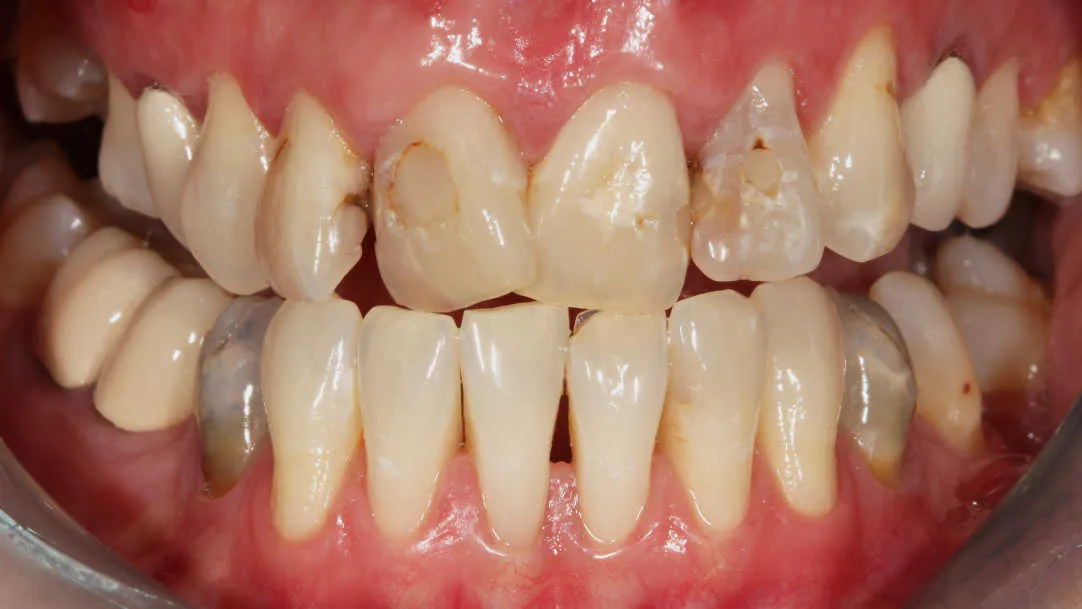 Reabilitare orală estetică și funcțională - înainte tratament