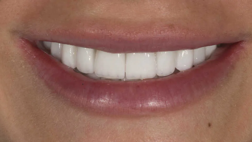Reabilitare orală estetică și funcțională - după tratament