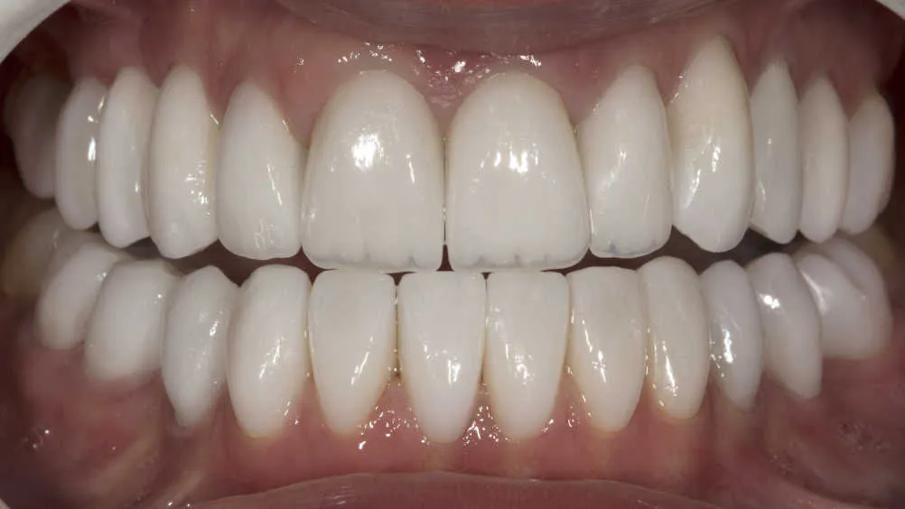 Reabilitare orală estetică și funcțională - după tratament