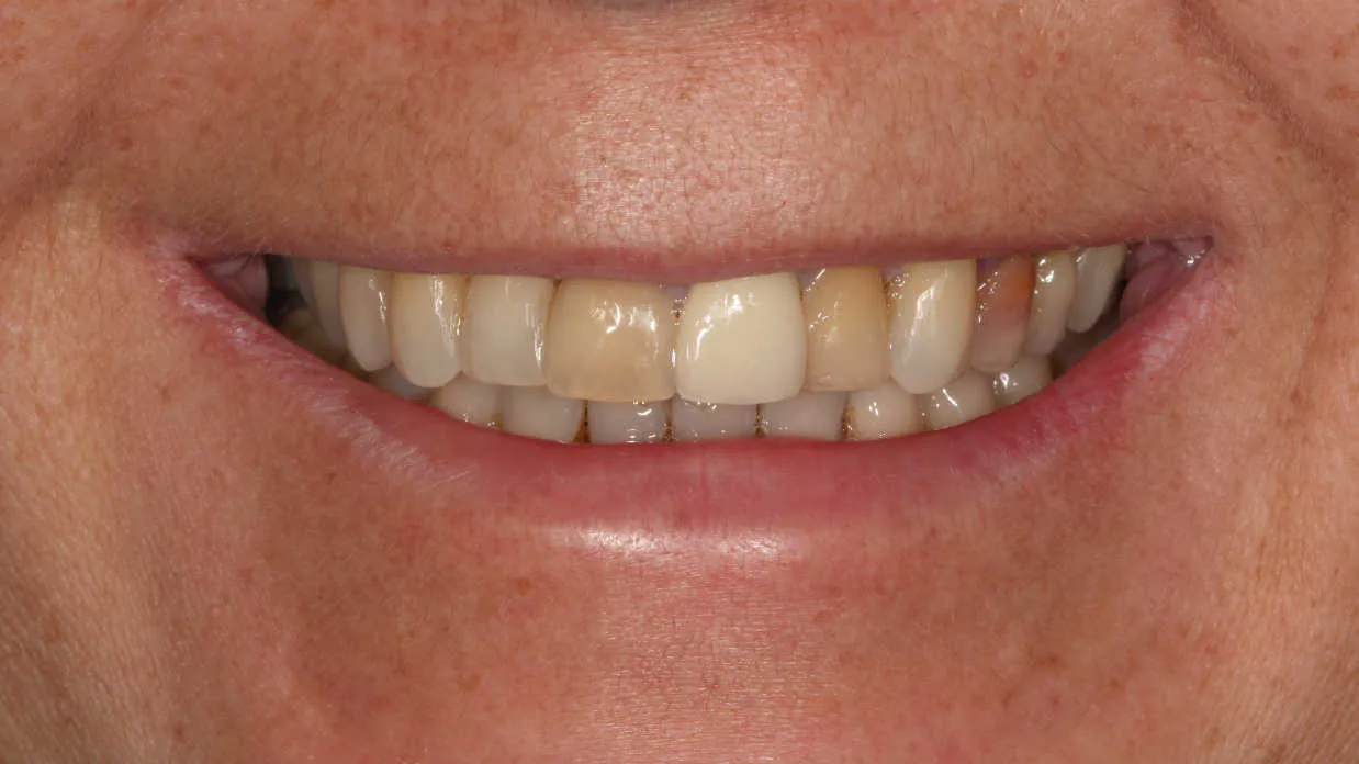 Reabilitare orală estetică și funcțională - înainte tratament