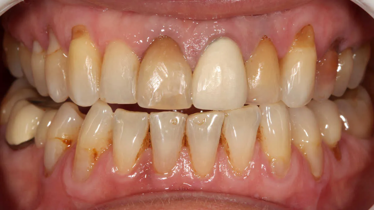 Reabilitare orală estetică și funcțională - înainte tratament