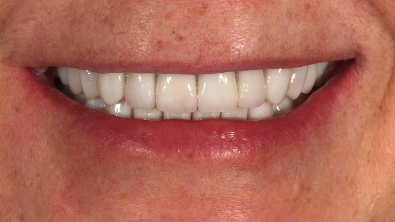 Reabilitare orală estetică și funcțională - după tratament