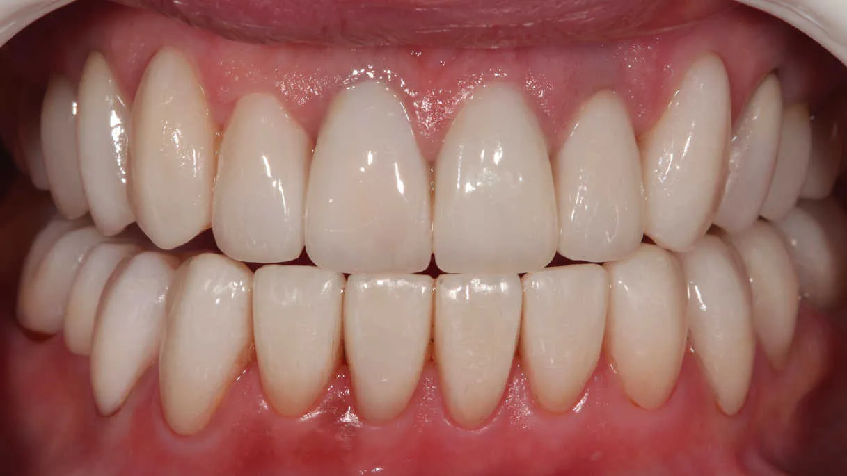 Reabilitare orală estetică și funcțională - după tratament