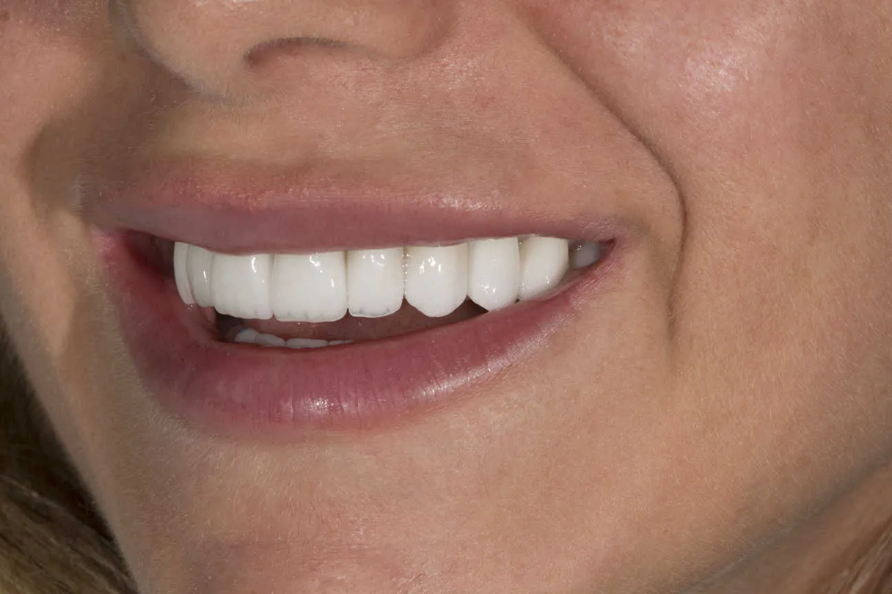 Zâmbet transformat prin tratament stomatologic la Olidental Clinic Timișoara - fotografia 33