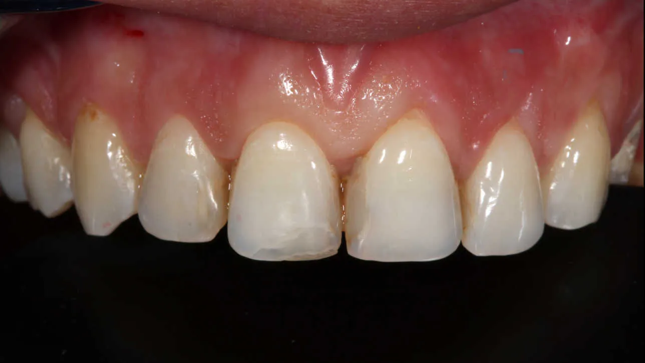 Fațete și coroane dentare integral ceramice - înainte tratament