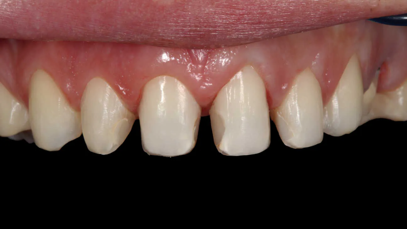 Fațete și coroane dentare integral ceramice - în lucru tratament