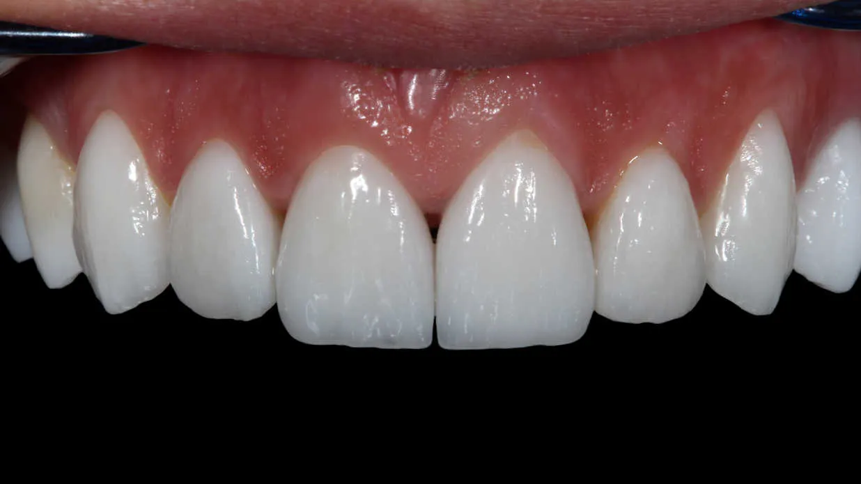 Fațete și coroane dentare integral ceramice - după tratament